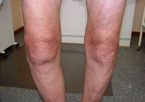 how to treat knee joint arthrosis