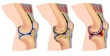 The development stage of knee joint arthrosis