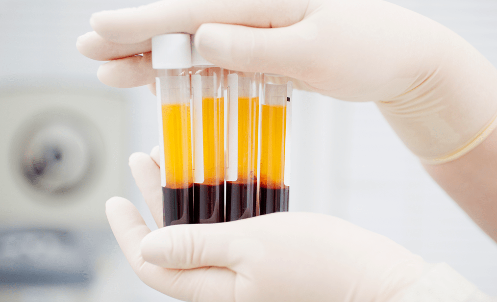 Platelet-rich plasma for PRP therapy for arthrosis